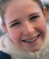 stock photo of girl with braces